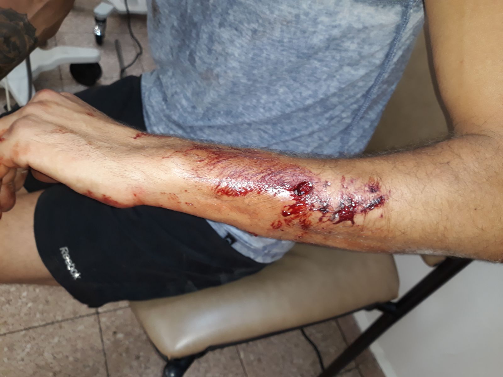 נ' פונה לטיפול רפואי ויזדקק לכמה ימי מנוחה אחרי הנשיכות והשריטות (צילום סלולרי)