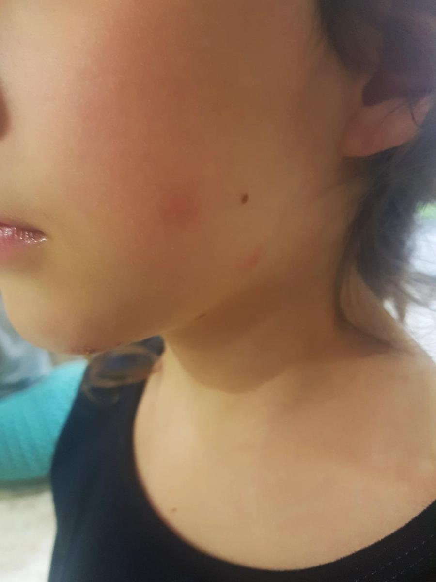 אחד הילדים שנעקצו (צילום סלולרי)