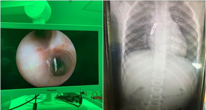 סורוקה: להב מחדד הוצא מריאה של ילדה בת 4