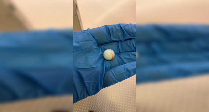 תינוקת נחנקה מגולת משחק, מצבה קשה