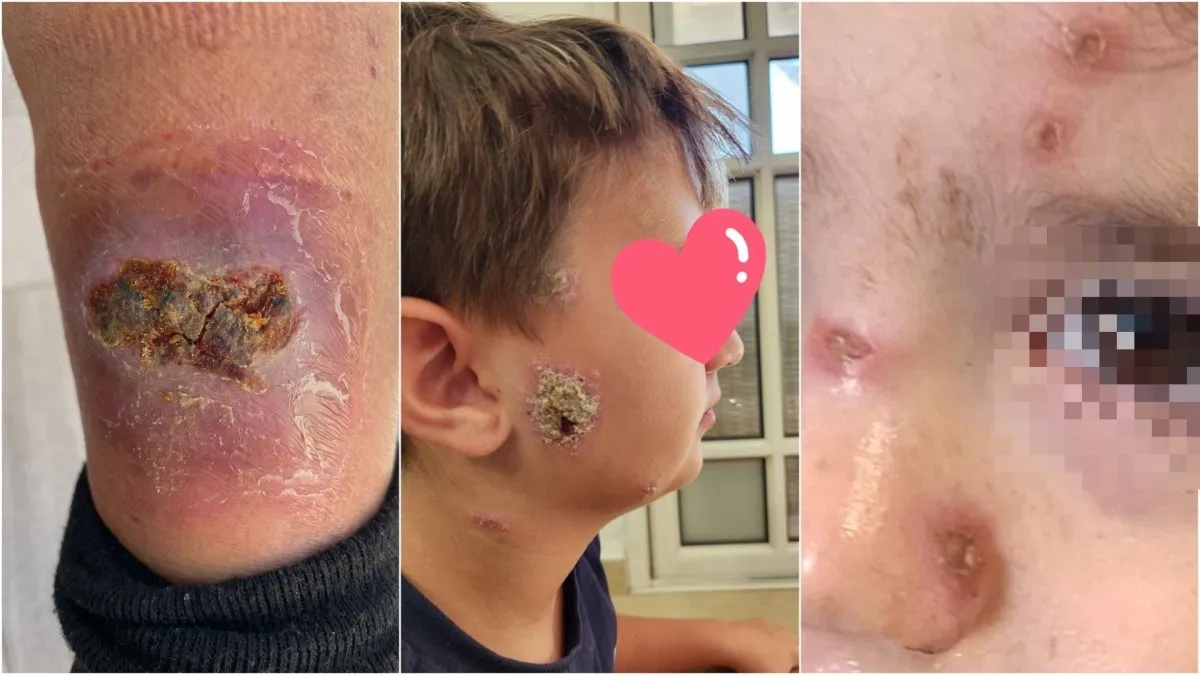 ''העיר נגועה'': אופקים מתמודדת עם מתקפת זבוב הגורם למחלה מסוכנת (תמונות קשות)