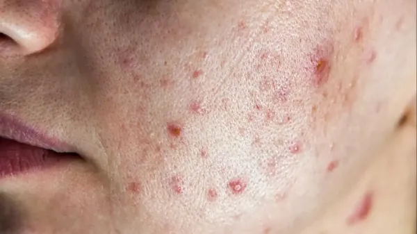 איך לזהות שינויים בעור שדורשים בדיקה מקצועית